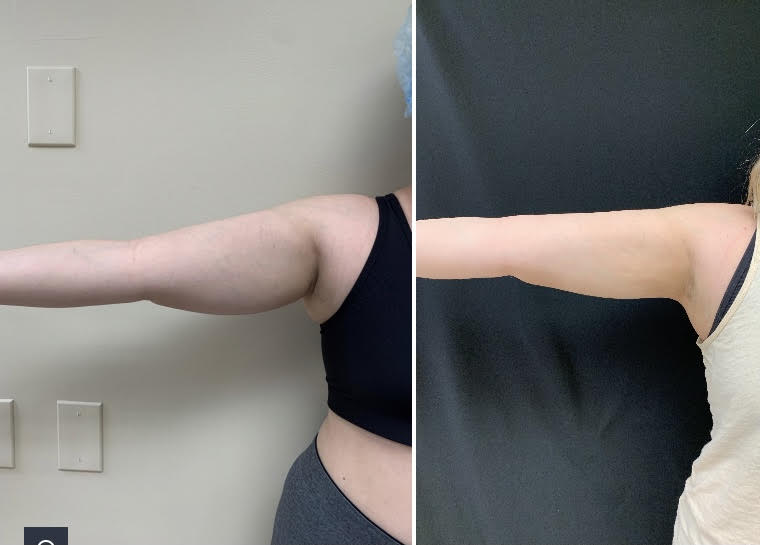Arm liposuction Dr Varano- Washington DC Arm liposuction Dr Varano- Washington DC